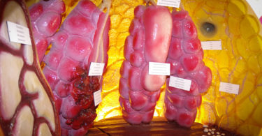 Brustkrebs