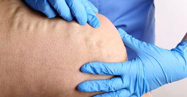 Varices - angiologie