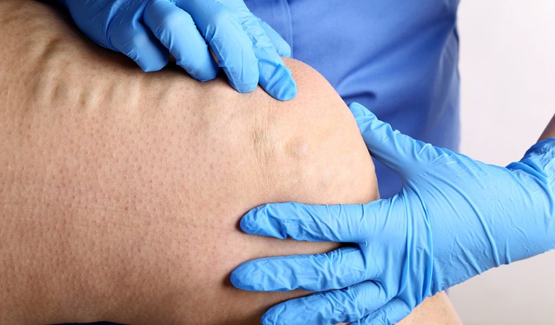 Varices - angiologie