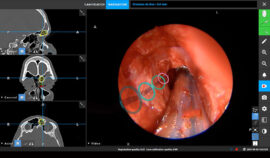 Chirurgie des sinus: une avancée majeure grâce à la réalité augmentée