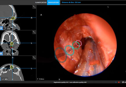 Chirurgie des sinus: une avancée majeure grâce à la réalité augmentée