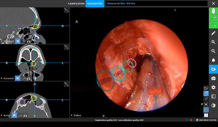 Chirurgie des sinus: une avancée majeure grâce à la réalité augmentée